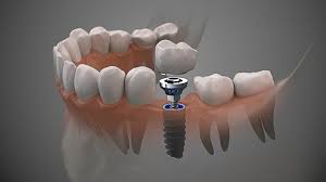 Implantes Dr Dopuglas Moura dentista Uberlandia